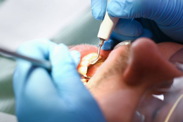 Best Emergency Treatment for Dental Infections or Abscesses in Wesley Chapel, FL